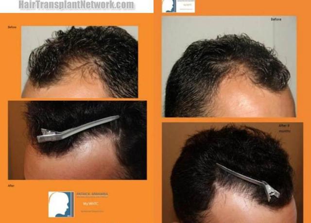 Hair transplantation surgery before and after photos