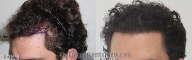 Hair transplantation surgery before and after images