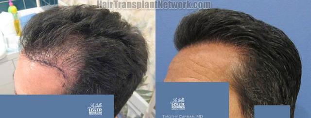 Hair transplantation surgery before and after pictures