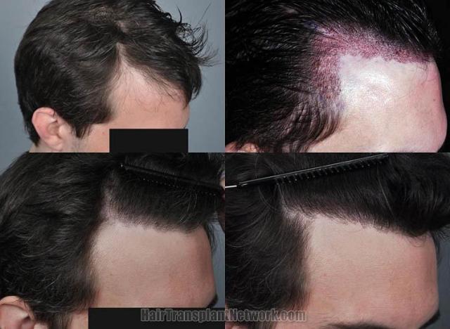 Hair restoration procedure before and after results