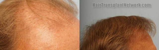 Hair transplantation surgery before and after pictures