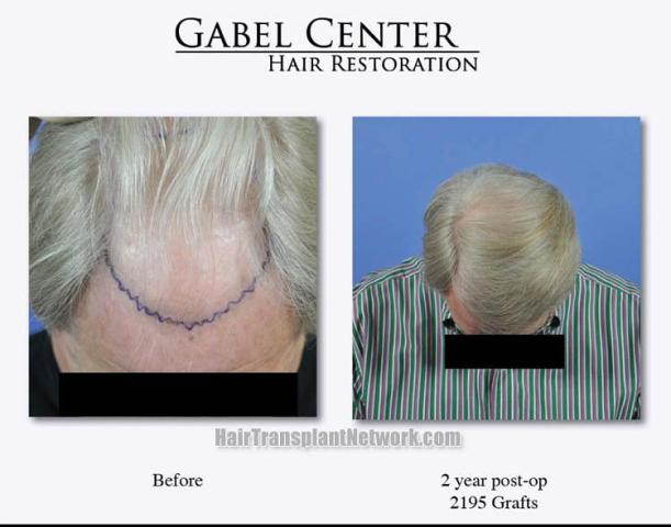 Top view before and after hair restoration results