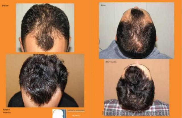 Hair restoration procedure before and after results