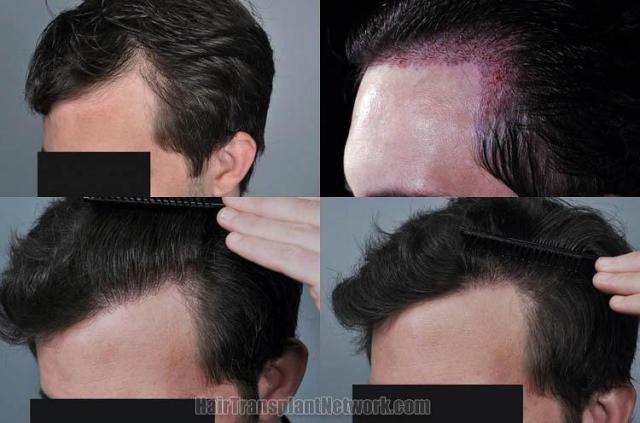 Hair transplantation surgery before and after photos