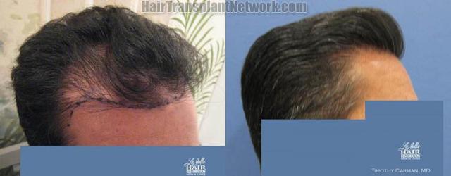 Hair transplantation surgery before and after images