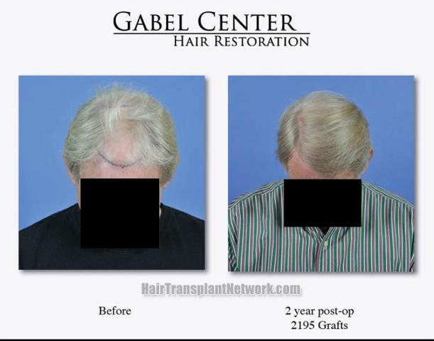 Hair restoration procedure before and after pictures