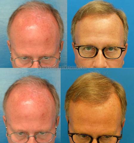 Hair restoration surgery before and after images