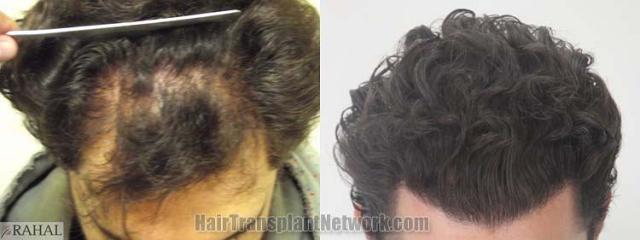 Hair restoration procedure before and after results