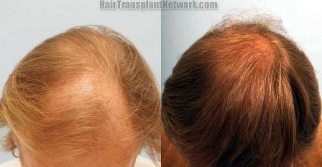 Hair transplantation surgery before and after images