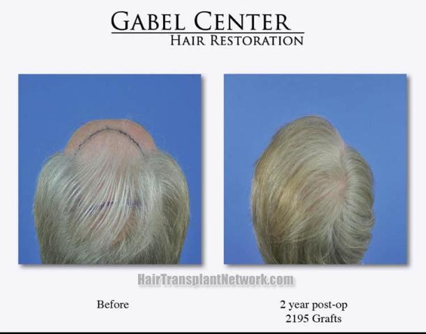 Hair transplantation surgery before and after photos