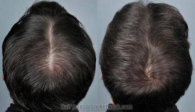 Hair transplantation surgery before and after images