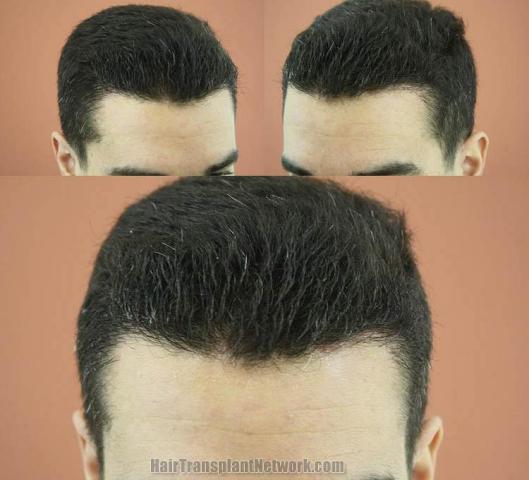 Hair transplantation surgery before and after pictures