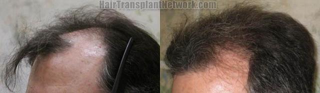 Hair restoration procedure before and after pictures