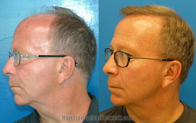 Hair transplantation surgery before and after pictures