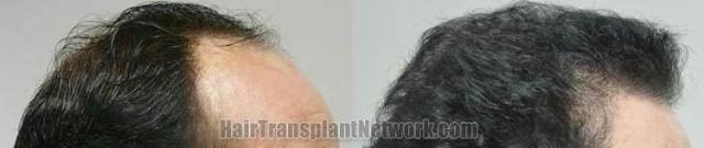 Hair transplantation surgery before and after images