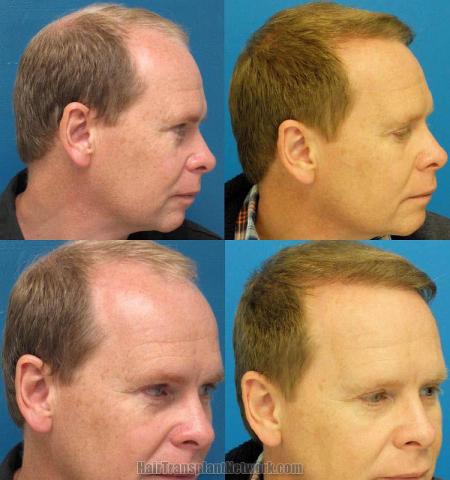 Hair transplantation surgery before and after images