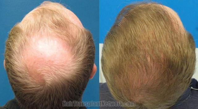 Hair restoration procedure before and after pictures