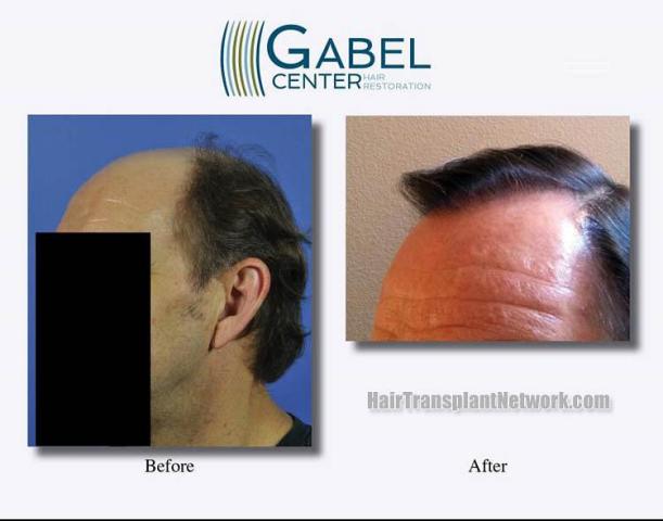 Hair transplantation surgery before and after pictures