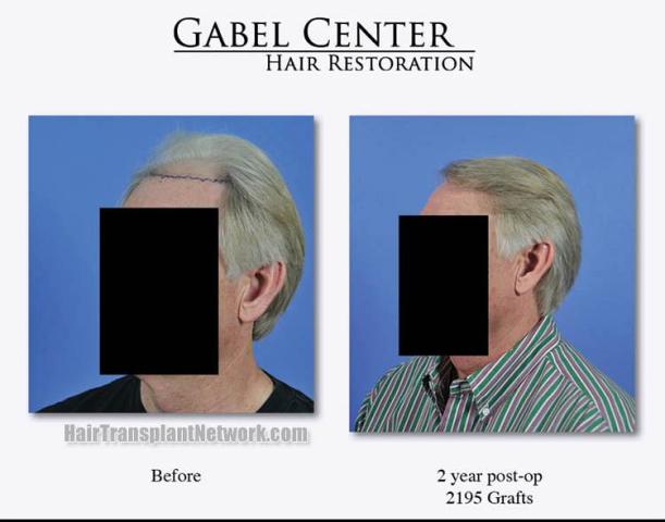 Hair restoration surgery before and after images