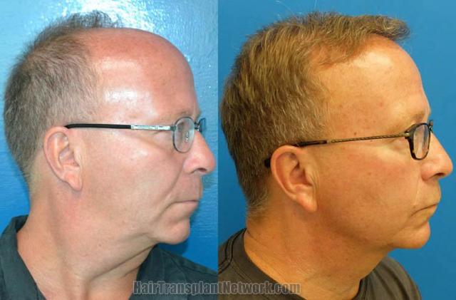 Hair transplantation surgery before and after images