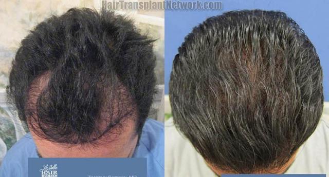 Hair transplantation surgery before and after photos