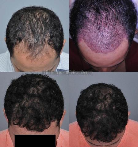 Hair restoration procedure before and after pictures