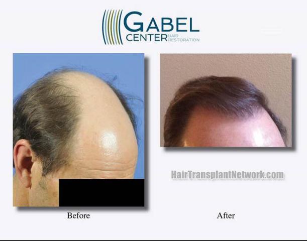 Hair transplantation surgery before and after images