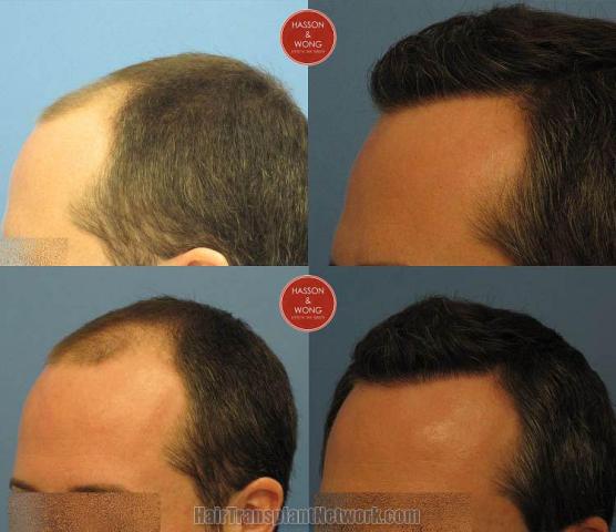 Hair transplantation surgery before and after pictures