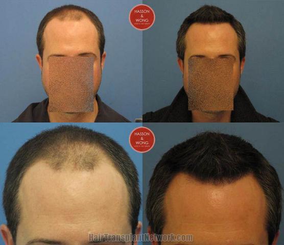 Hair restoration procedure before and after results