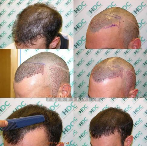 hair transplantation surgery before and after images