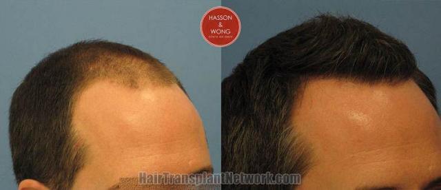 Hair transplantation surgery before and after images