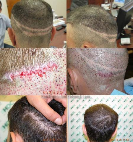 Hair transplantation surgery before and after pictures