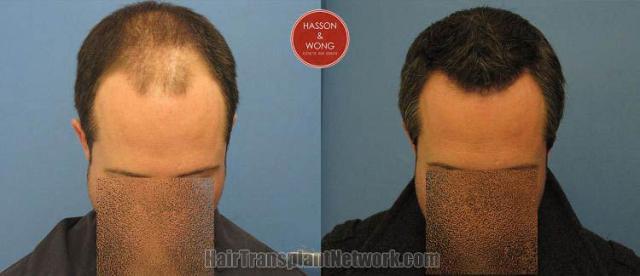 Hair transplantation surgery before and after photos