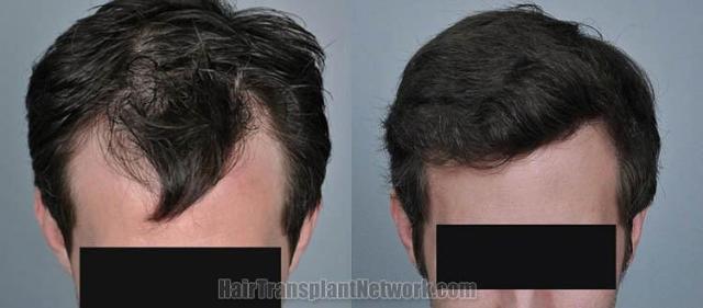 Before and after hair transplantation result photographs