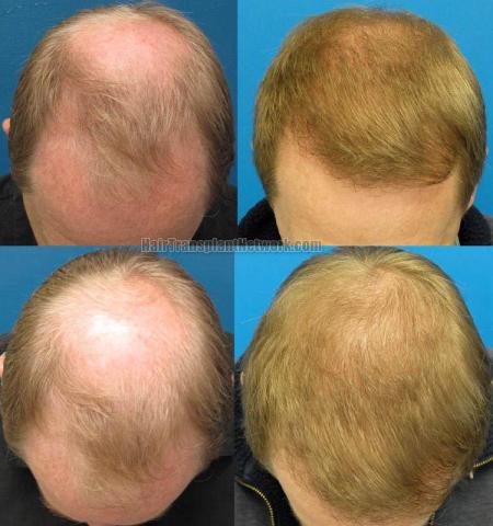 Hair transplantation surgery before and after photos