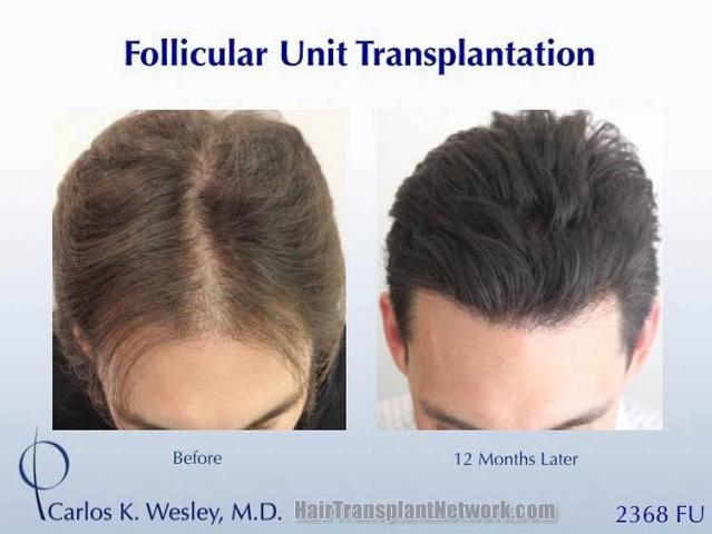 Hair transplantation surgery before and after images