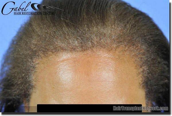 Hair restoration procedure results