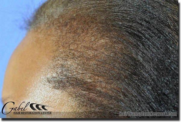 Hair restoration procedure results