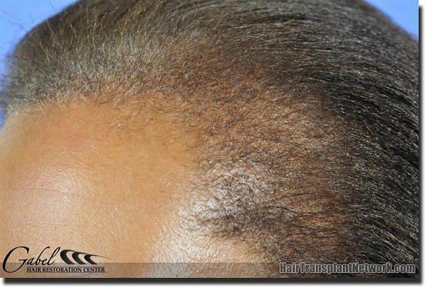 Hair restoration procedure results