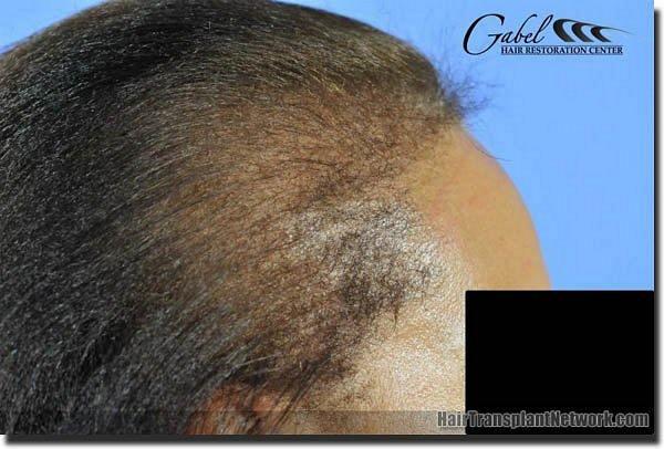 Hair restoration procedure results