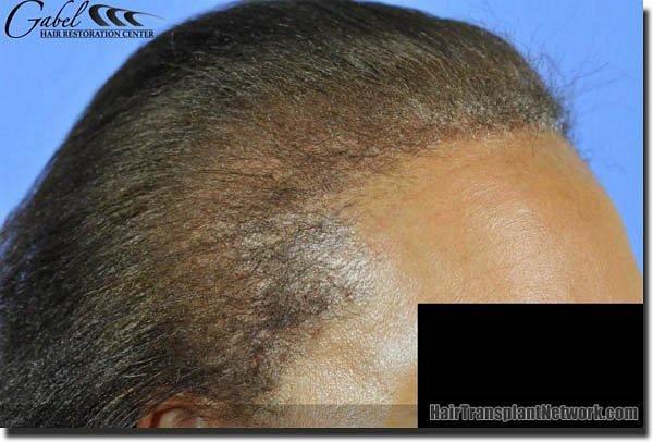 Hair restoration procedure results