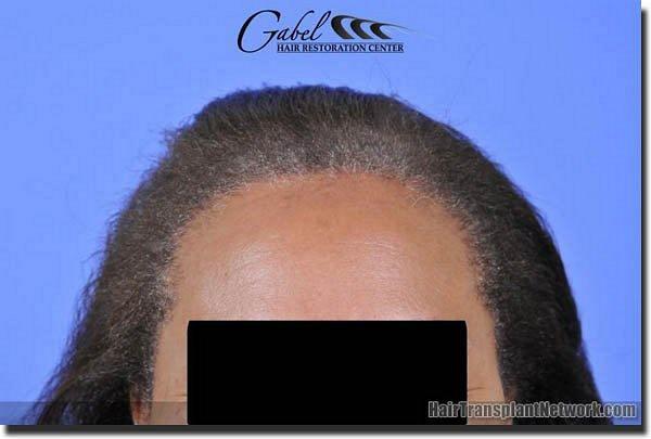 Hair restoration procedure results