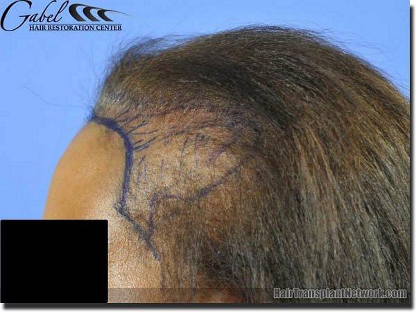 Hair restoration procedure results