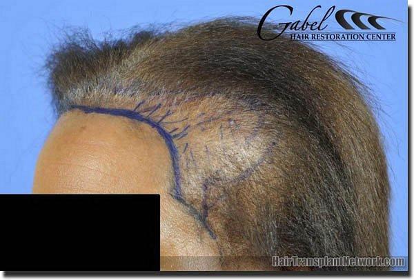 Hair restoration procedure results