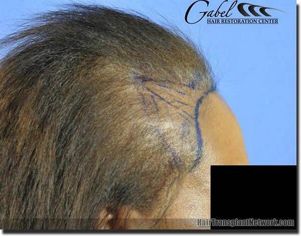 Hair restoration procedure results