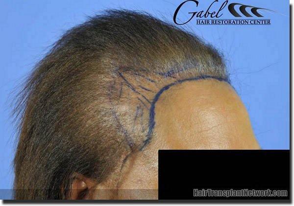 Hair restoration procedure results