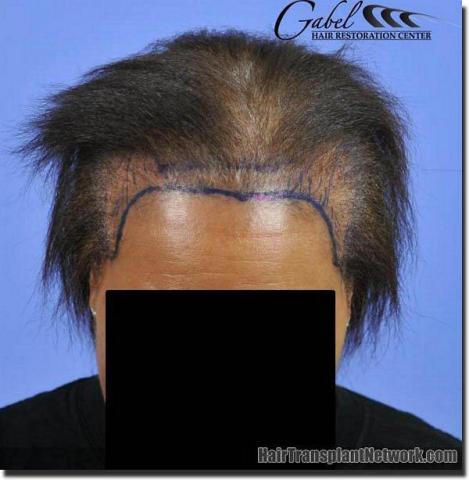 Hair restoration procedure results