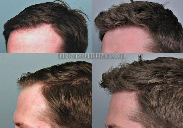 Hair transplantation surgery before and after photos