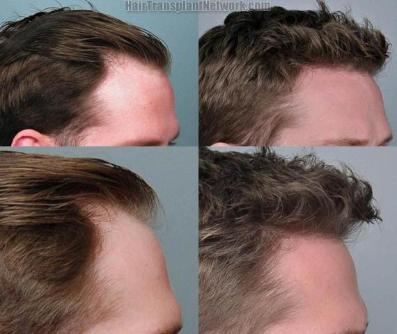 Hair restoration procedure before and after results