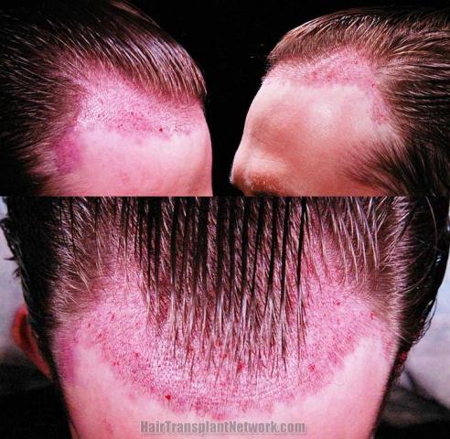 Surgical hair transplantation result photographs